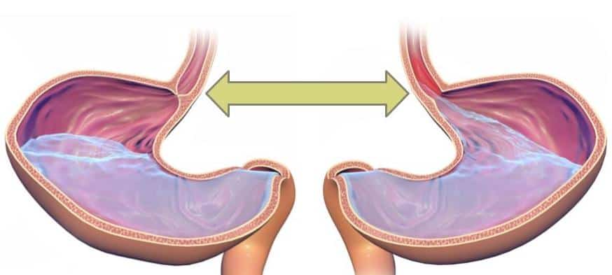 Stomach acid spilling through the esophageal sphincter